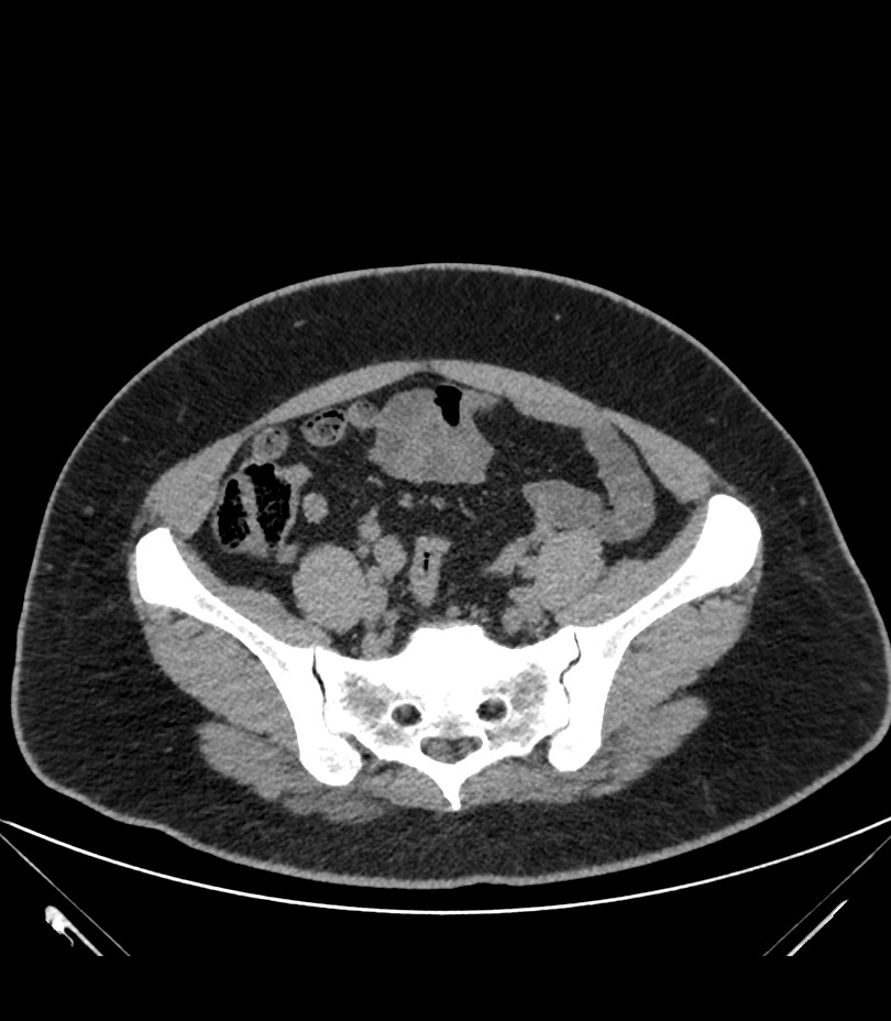 Cervical aortic arch with coarctation and aneurysms (Radiopaedia 44035-47552 Axial non-contrast 80).jpg