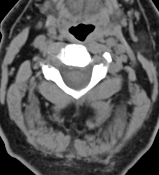 File:Cervical canal stenosis due to ossification of the posterior longitudinal ligament (Radiopaedia 47260-51823 Axial non-contrast 20).png
