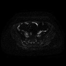 File:Cervical carcinoma (Radiopaedia 85405-101028 Axial DWI 17).jpg