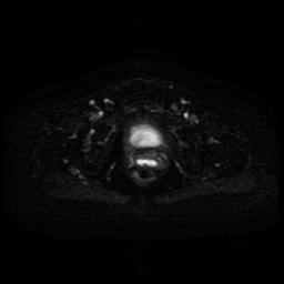 Cervical carcinoma (Radiopaedia 85405-101028 Axial DWI 5).jpg