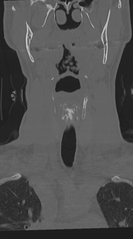 Cervical intercalary bone (Radiopaedia 35211-36748 Coronal bone window 16).png