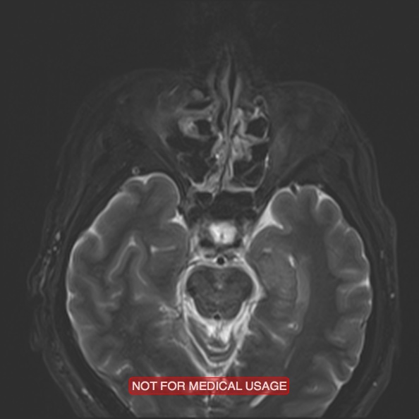 Cervical nerve schwannoma (Radiopaedia 27964-28221 C 10).jpg