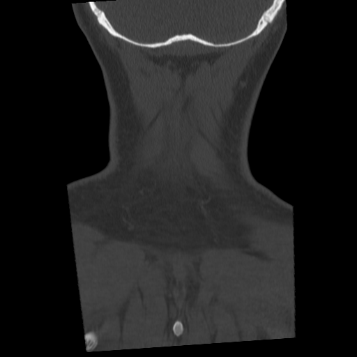 Cervical schwannoma (Radiopaedia 57979-64974 Coronal bone window 54).png