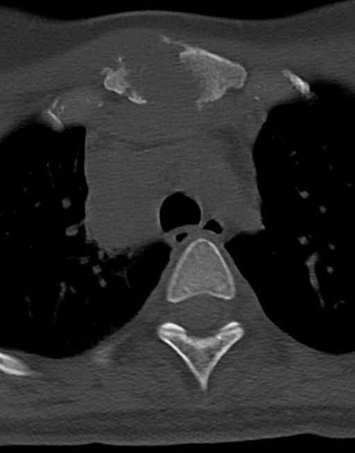 Cervical tuberculous spondylitis (Radiopaedia 39149-41365 Axial bone window 59).png