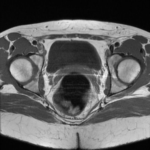 File:Cesarian section scar endometriosis (Radiopaedia 66520-75799 Axial T1 17).jpg