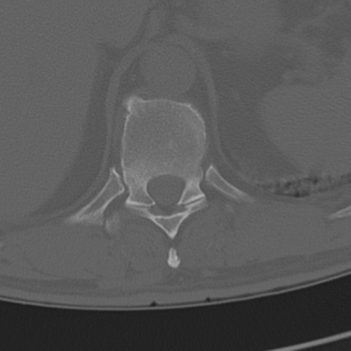 Chance fracture (Radiopaedia 33854-35020 Axial bone window 75).png