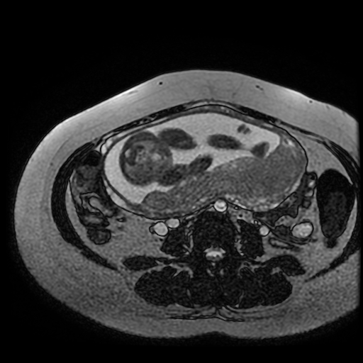Chiari II malformation - fetal MRI (Radiopaedia 68099-77581 Axial Fiesta 9).jpg