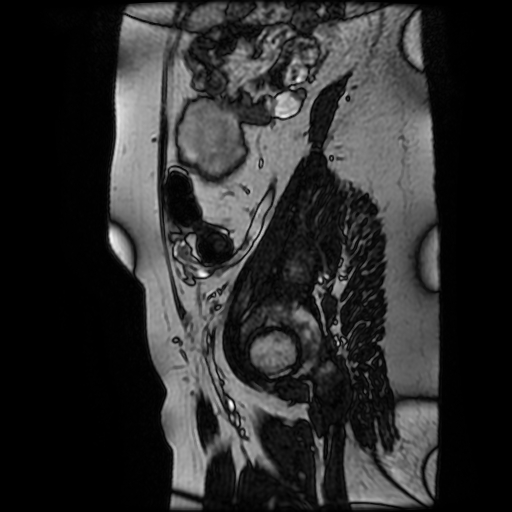 Chiari II malformation - fetal MRI (Radiopaedia 68099-77581 Sagittal Fiesta 48).jpg