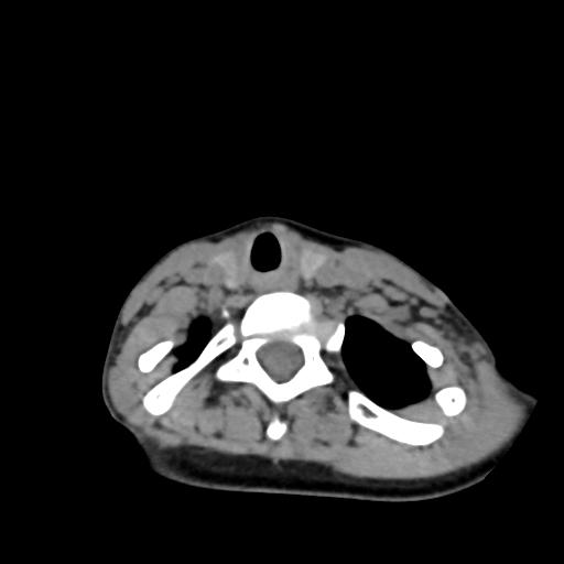 Chiari I with syrinx and skull base anomalies (Radiopaedia 89444-106412 Axial non-contrast 117).jpg
