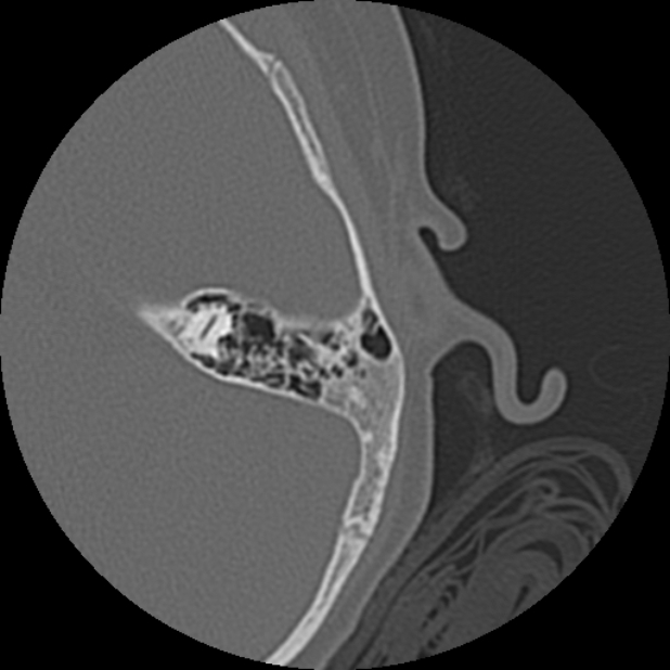 Cholesteatoma (Radiopaedia 73023-83750 Axial Left ear 67).jpg
