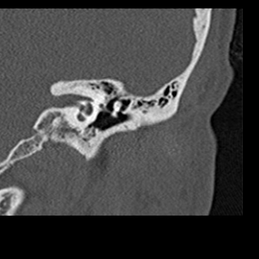 File:Cholesteatoma of the external ear (Radiopaedia 16540-16225 Coronal bone window 9).jpg