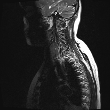 File:Chondrosarcoma - chest wall (Radiopaedia 65192-74200 Sagittal T2 1).jpg