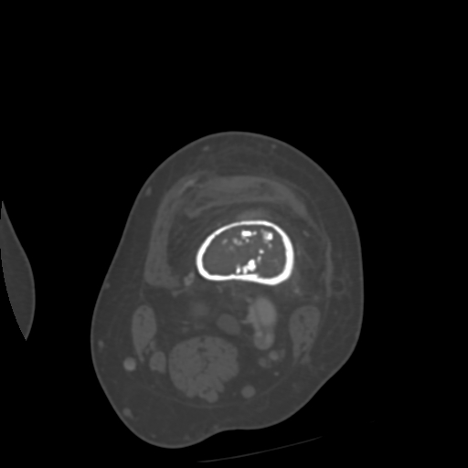 Chondrosarcoma - femur (Radiopaedia 64187-72954 Axial bone window 21).jpg