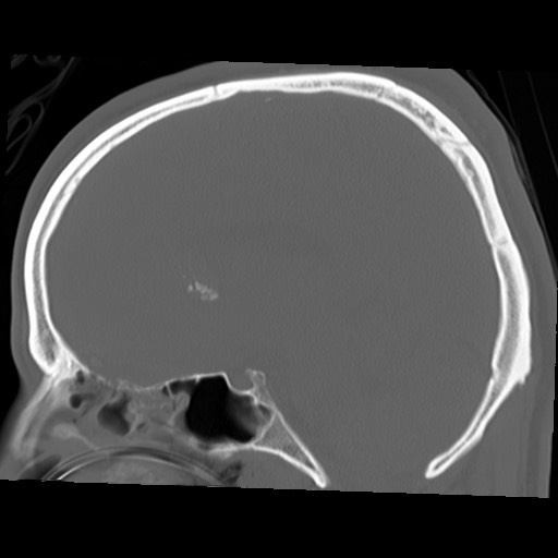 File:Chondrosarcoma - sphenoid wing (Radiopaedia 58259-67828 Sagittal bone window 16).jpg