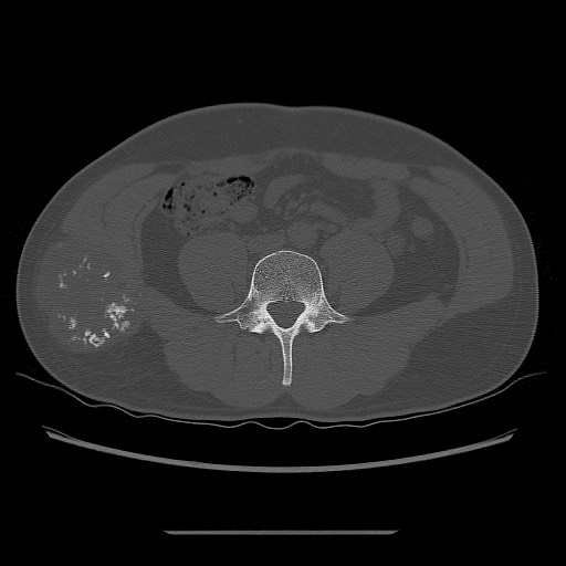 File:Chondrosarcoma of iliac wing (Radiopaedia 63861-72599 Axial bone window 25).jpg