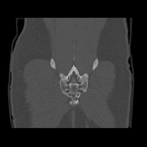 Chondrosarcoma of iliac wing (Radiopaedia 63861-72599 Coronal bone window 101).jpg