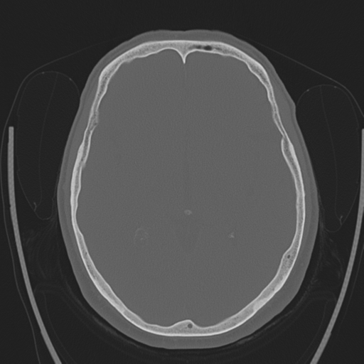 File:Chondrosarcoma of skull base- grade II (Radiopaedia 40948-43653 Axial bone window 23).png