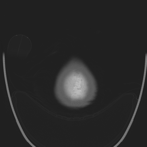 Chondrosarcoma of skull base- grade II (Radiopaedia 40948-43653 Axial bone window 51).png