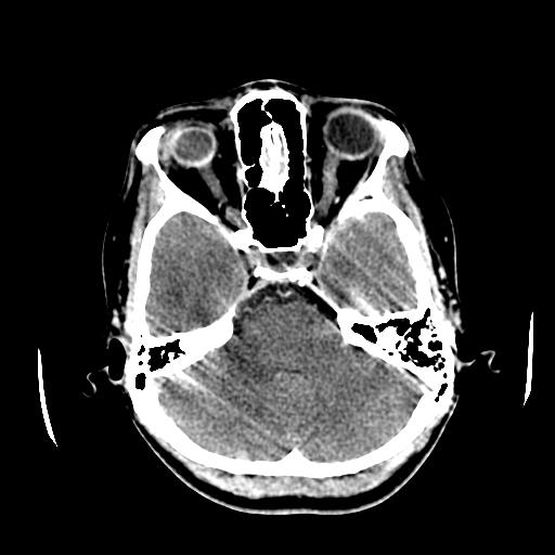 File:Choriocarcinoma of ovary with cerebral and pulmonary metastases (Radiopaedia 25983-26118 C+ arterial phase 40).jpg
