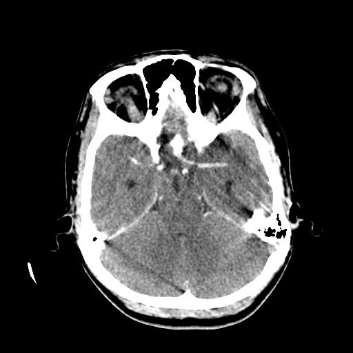 File:Choriocarcinoma of ovary with cerebral and pulmonary metastases (Radiopaedia 25983-26118 C+ arterial phase 49).jpg