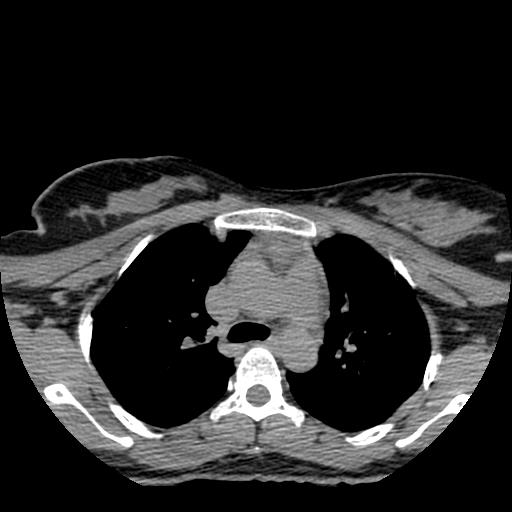 File:Choriocarcinoma of ovary with cerebral and pulmonary metastases (Radiopaedia 25983-26119 Axial non-contrast 114).jpg