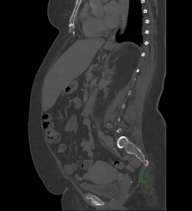 Chromophobe renal cell carcinoma (Radiopaedia 84239-99519 Sagittal bone window 48).jpg
