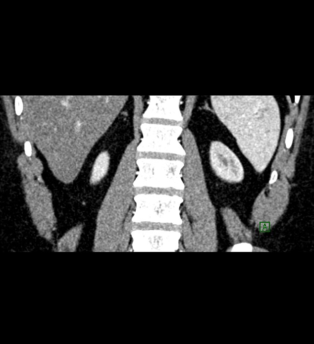 Chromophobe renal cell carcinoma (Radiopaedia 84286-99573 E 71).jpg