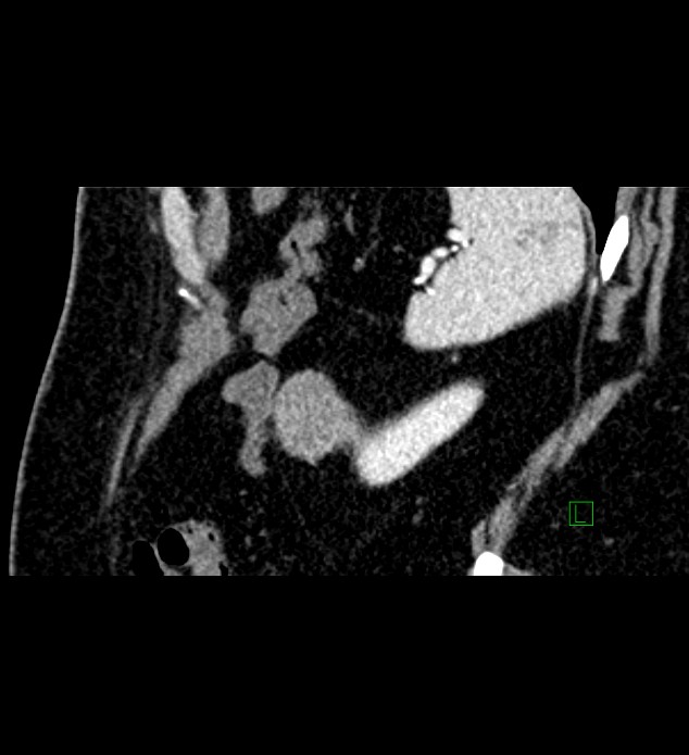 Chromophobe renal cell carcinoma (Radiopaedia 84286-99573 F 25).jpg
