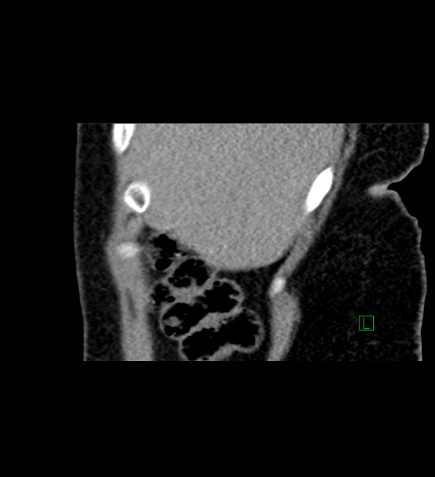 Chromophobe renal cell carcinoma (Radiopaedia 84290-99582 D 86).jpg