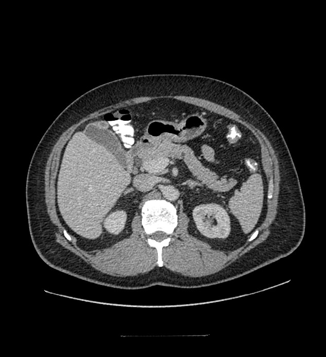 Chromophobe renal cell carcinoma (Radiopaedia 84337-99644 C 45).jpg