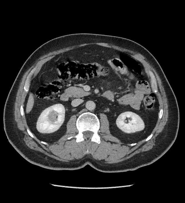 Chromophobe renal cell carcinoma (Radiopaedia 86879-103083 C 61).jpg
