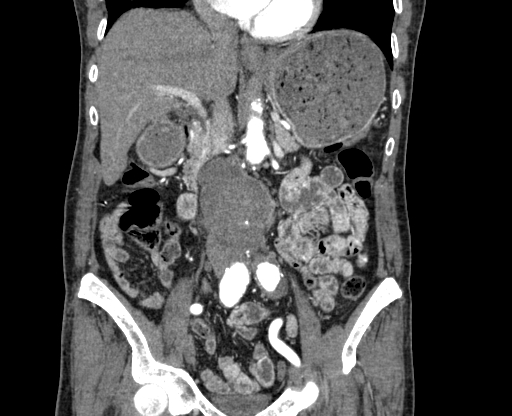 File:Chronic contained rupture of abdominal aortic aneurysm with extensive erosion of the vertebral bodies (Radiopaedia 55450-61901 D 31).jpg