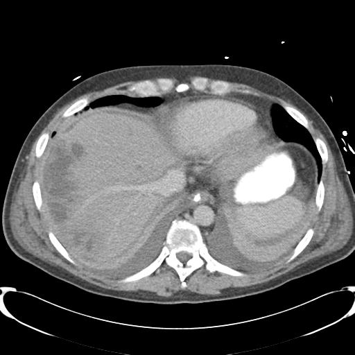 Chronic diverticulitis complicated by hepatic abscess and portal vein thrombosis (Radiopaedia 30301-30938 A 12).jpg