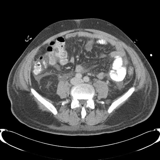 Chronic diverticulitis complicated by hepatic abscess and portal vein thrombosis (Radiopaedia 30301-30938 A 60).jpg