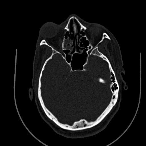 Chronic invasive fungal sinusitis (Radiopaedia 91563-109286 Axial sinus 69).jpg