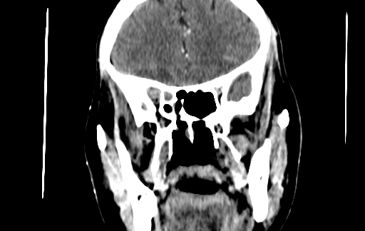 Chronic invasive fungal sinusitis (Radiopaedia 91563-109286 D 69).jpg