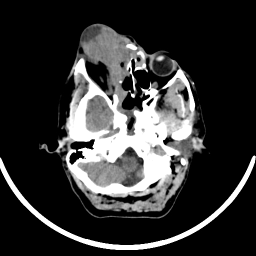 File:Chronic invasive fungal sinusitis with intraorbital and intracranial extension (Radiopaedia 56387-63046 Axial non-contrast 110).jpg