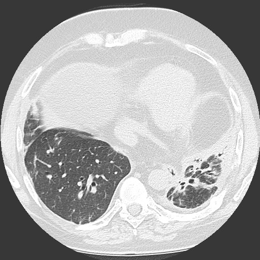 Chronic lung allograft dysfunction - restrictive form (Radiopaedia 60595-68316 Axial lung window 51).jpg