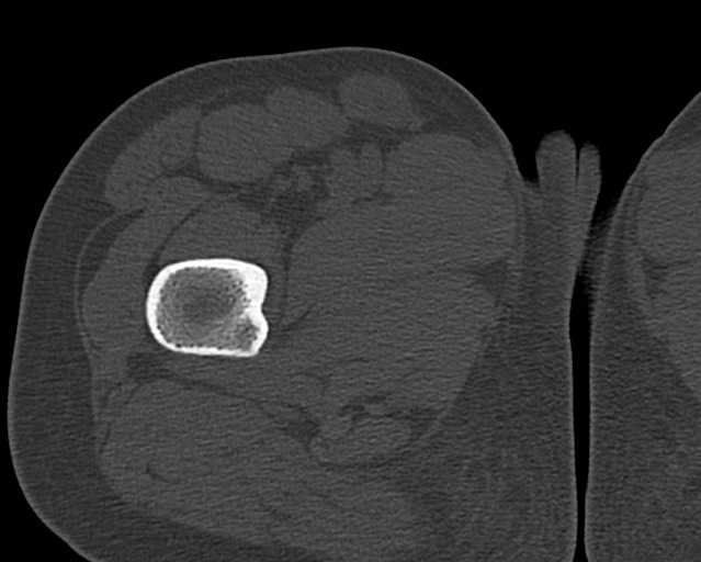 Chronic ostemyelitis of the femur with long sinus tract (Radiopaedia 74947-85982 Axial bone window 29).jpg
