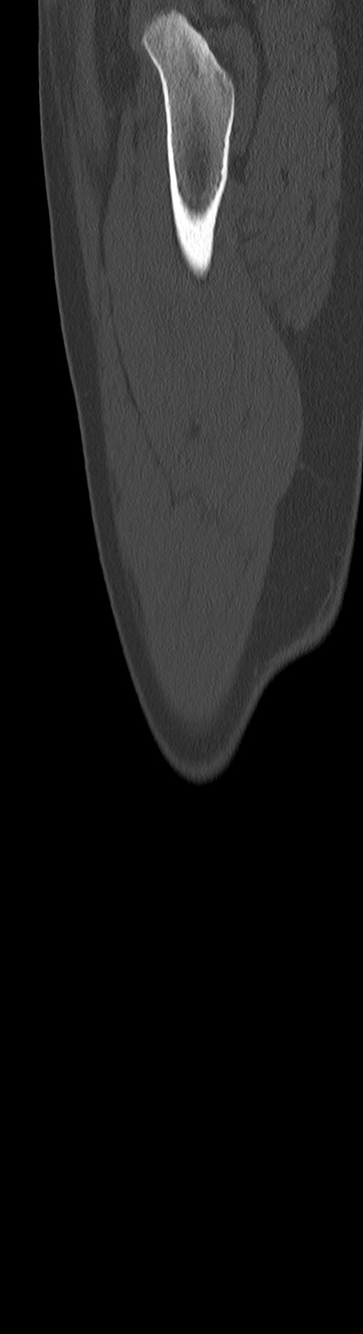 Chronic ostemyelitis of the femur with long sinus tract (Radiopaedia 74947-85982 Sagittal bone window 25).jpg