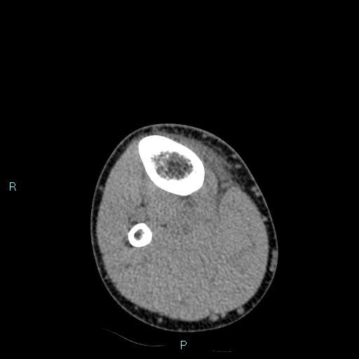 Chronic osteomyelitis (with Brodie abscess) (Radiopaedia 76405-88111 A 46).jpg