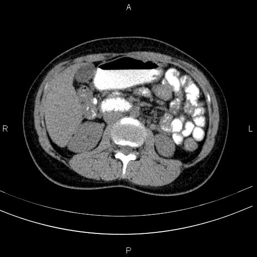 Chronic pancreatitis (Radiopaedia 64576-73450 Axial non-contrast 69).jpg