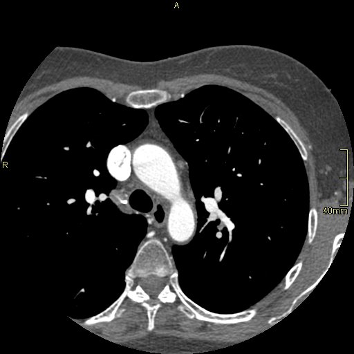 Chronic pulmonary embolism (Radiopaedia 73073-85094 Axial C+ CTPA 31).jpg