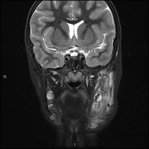 File:Chronic reactive multifocal osteomyelitis (CRMO) - mandible (Radiopaedia 56405-63069 Coronal STIR 17).jpg