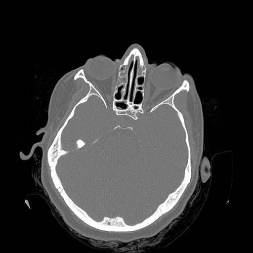 Chronic sinusitis with intra-sinus calcification (Radiopaedia 63919-72668 Axial bone window 14).jpg