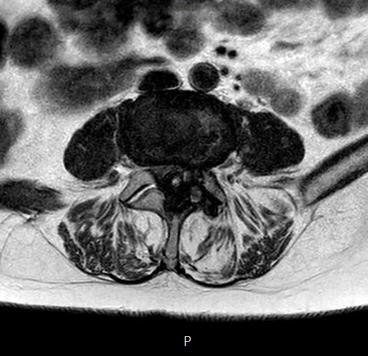 File:Chronic spinal hematoma with cauda equina syndrome (Radiopaedia 75745-87090 Axial T2 13).png