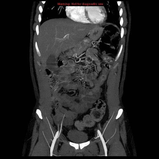 File:Circumaortic left renal vein (Radiopaedia 9069-9792 B 4).jpg