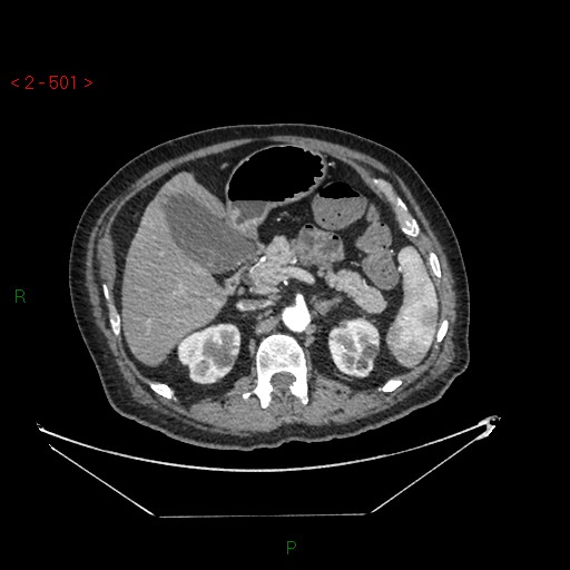 Circumaortic left renal vein and doubled left renal arteries (Radiopaedia 52268-58158 A 37).jpg