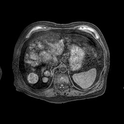 File:Cirrhosis and hepatocellular carcinoma in the setting of hemochromatosis (Radiopaedia 75394-86594 Axial T1 C+ fat sat 51).jpg