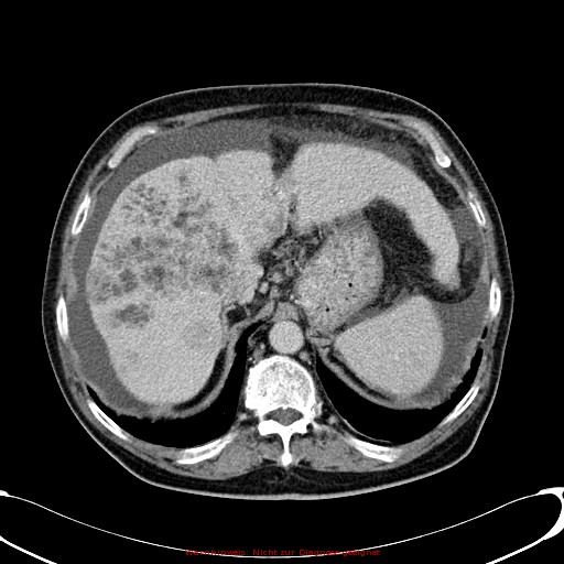 File:Cirrhosis and hepatocellular carcinoma in the setting of hemochromatosis (Radiopaedia 75394-86595 B 24).jpg